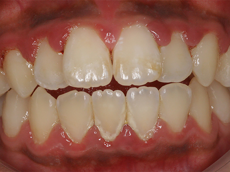 炎 治療 歯肉 歯肉炎の症状レベルをチェック！最適な治療法・費用・歯医者の選び方